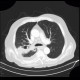 Pulmonary tuberculosis, TBC, tuberculosis: CT - Computed tomography